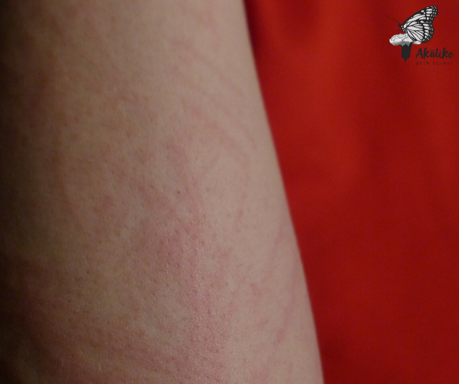 pigmentation removal Sydney