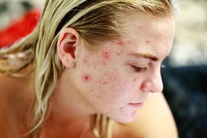 pigmentation removal in Sydney